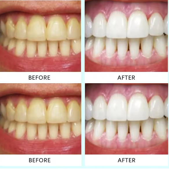 Tiras blanqueadoras dentales (box2)