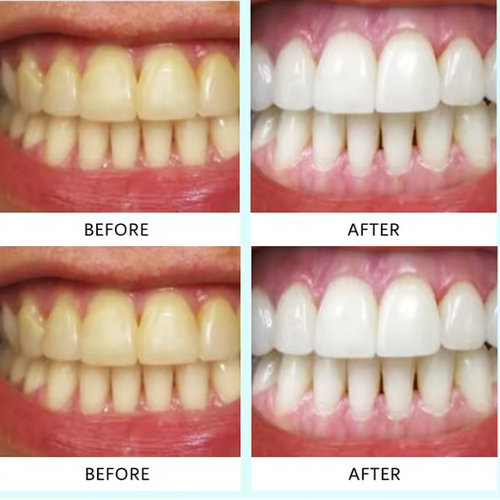 Tiras blanqueadoras dentales (box2)